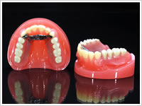 金属床義歯イメージ写真